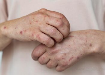 Refuerzan vigilancia sanitaria en Salta por alerta de sarampión en la región