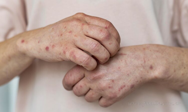 Refuerzan vigilancia sanitaria en Salta por alerta de sarampión en la región