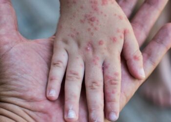 Confirman dos casos de viruela del mono en Salta: investigan posible transmisión local