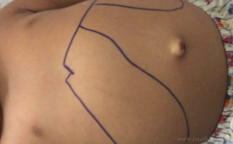 Regionales: más control ante aumento de casos de leishmaniasis visceral